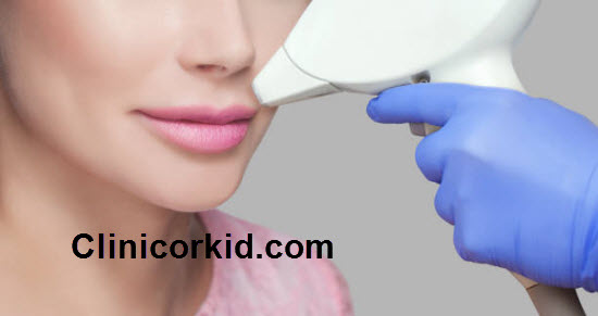 هزینه لیزر موهای زائد صورت کلینیک ارکید