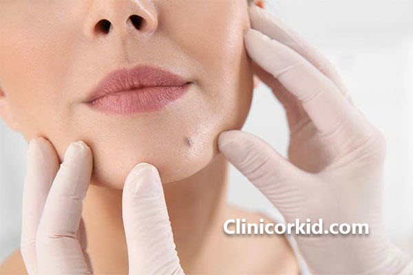 بهترین کلینیک برداشتن خال مادر زادی در غرب تهران | کلینیک ارکید