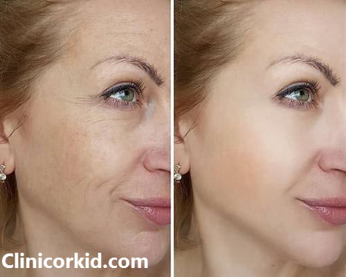 قیمت هایفوتراپی صورت_کلینیک ارکید