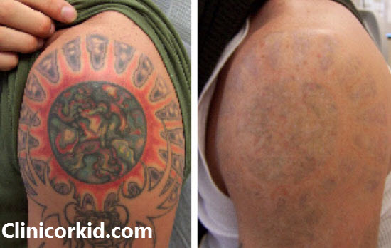 پاک کردن تاتو با لیزر کیوسوئیچ در غرب تهران-کلینیک ارکید