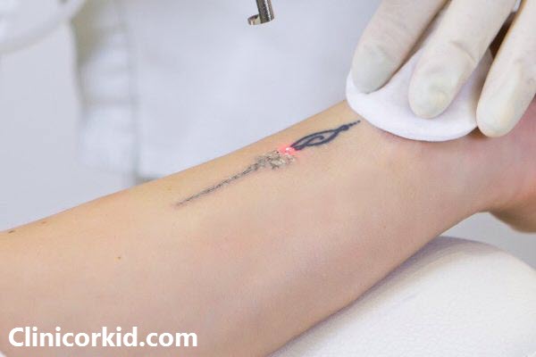 پاک کردن تاتو با لیزر کیوسوئیچ در غرب تهران کلینیک ارکید
