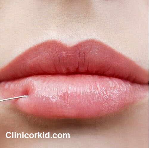 برترین کلینیک تزریق ژل لب در پونک - کلینیک ارکید