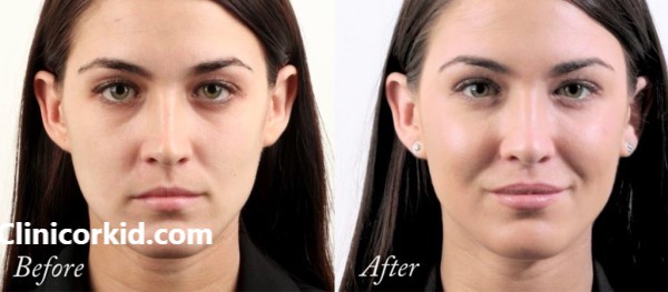 تزریق ژل گونه در غرب تهران با بهترین قیمت | کلینیک ارکید