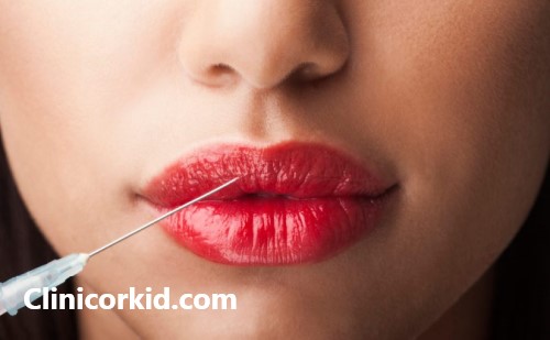 آشنایی با مراقبت بعد از تزریق ژل لب | کلینیک ارکید