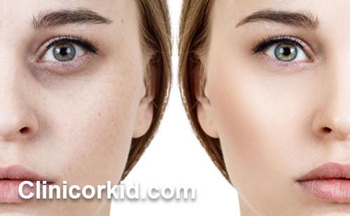 هزینه فیلر زیر چشم چقدر است؟ کلینیک ارکید