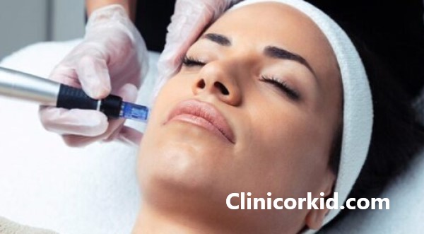 قیمت میکرونیدلینگ صورت در پونک - کلینیک ارکید