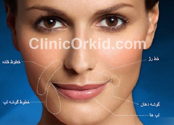 رفع خط خنده با تزریق ژل در غرب تهران | کلینیک تخصصی ارکید