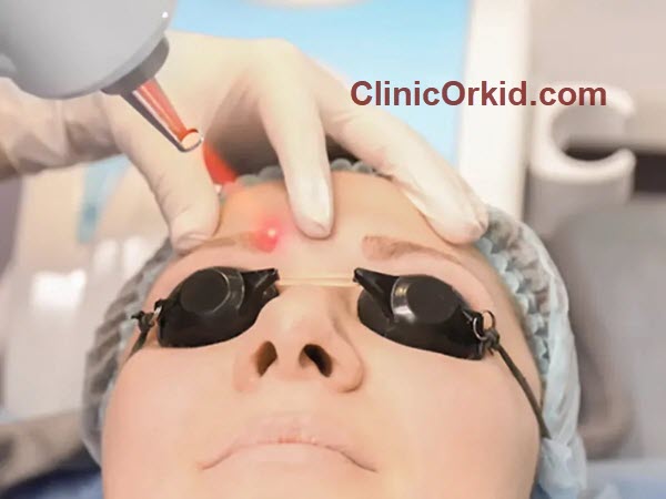 هزینه پاک کردن تاتو با لیزر چقدر است؟ | کلینیک ارکید