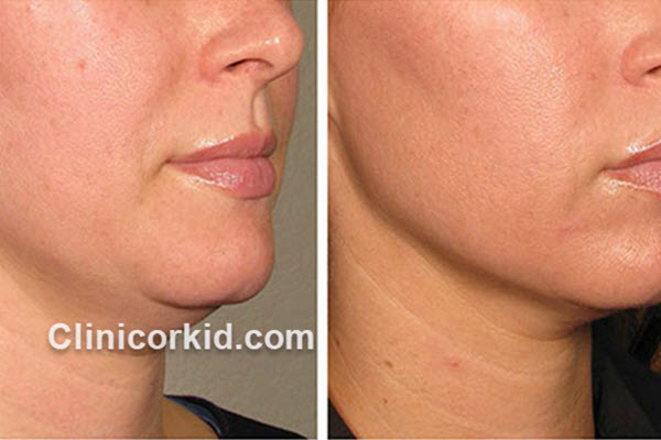 مراقبت های بعد از هایفوتراپی چیست | کلینیک ارکید