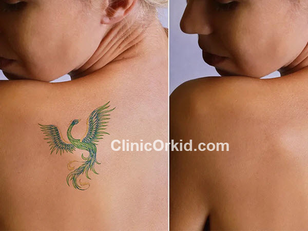 هزینه پاک کردن تاتو با لیزر چقدر است؟ | کلینیک ارکید