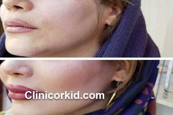 ماندگاری تزریق ژل گونه چقدر است | کلینیک ارکید