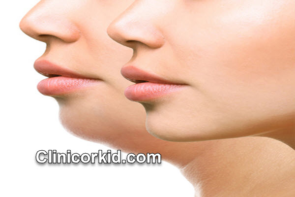 هایفوتراپی غبغب با هزینه مناسب در غرب تهران | کلینیک ارکید