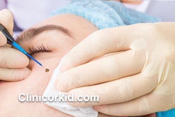 هزینه برداشتن خال با لیزر چقدر است | کلینیک ارکید