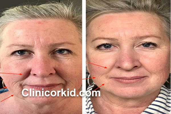 جوانسازی پوست با هایفوتراپی در غرب تهران | کلینیک ارکید