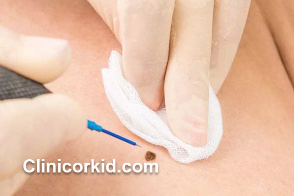 هزینه برداشتن خال با لیزر چقدر است | کلینیک ارکید