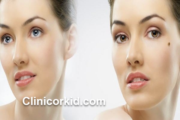 هزینه برداشتن خال با لیزر چقدر است | کلینیک ارکید