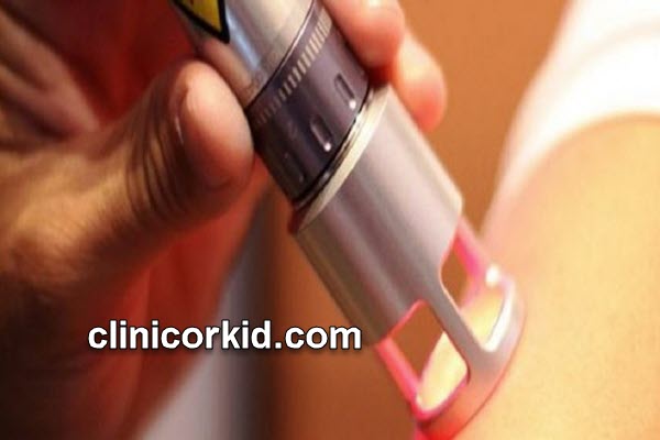 جلوگیری از سوختگی با پماد بتامتازون بعد از لیزر | کلینیک ارکید