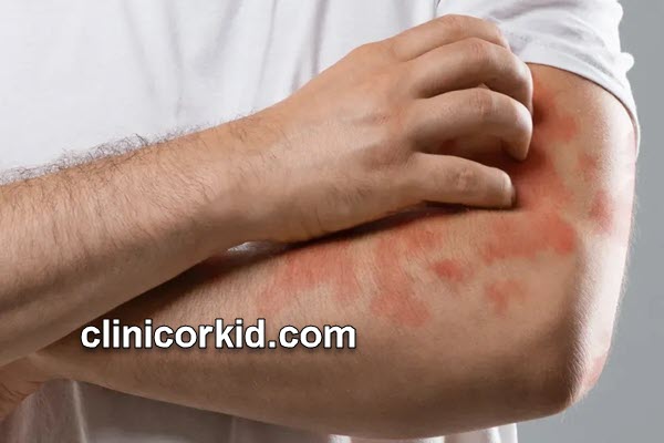 جلوگیری از سوختگی با پماد بتامتازون بعد از لیزر | کلینیک ارکید