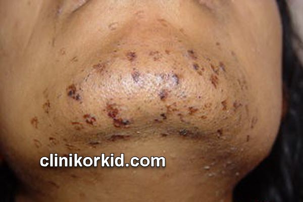 آیا لیزر موهای زائد ضرر دارد؟ | کلینیک ارکید