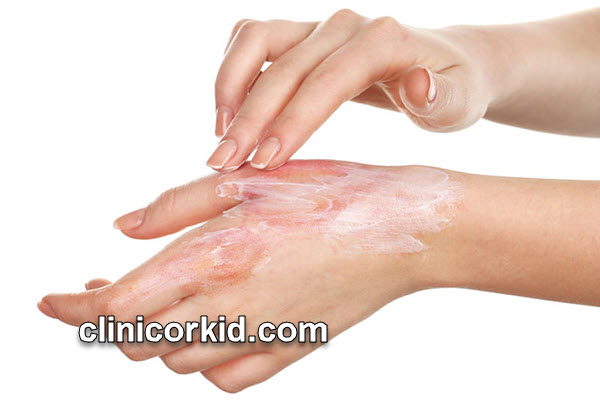 جلوگیری از سوختگی با پماد بتامتازون بعد از لیزر | کلینیک ارکید