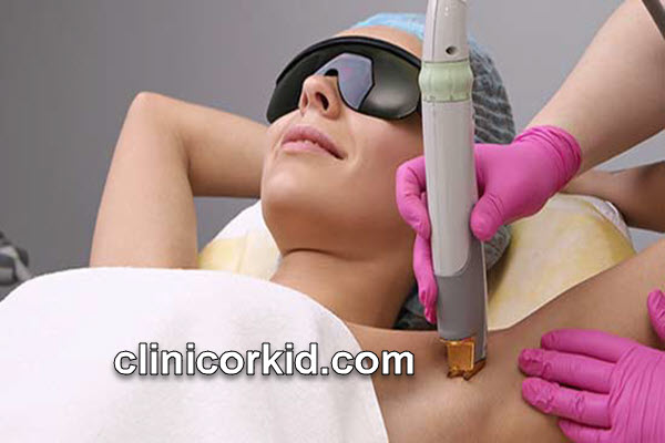 لیزر موهای زائد بعد از سولاریوم | کلینیک ارکید