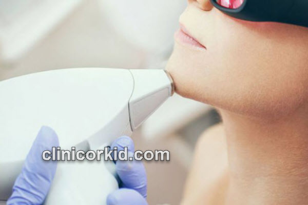 لیزر موهای زائد زیر چانه با قیمت مناسب | کلینیک ارکید