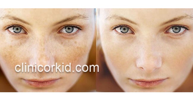 لیزر لکه های قهوه ای پوست در غرب تهران | کلینیک ارکید