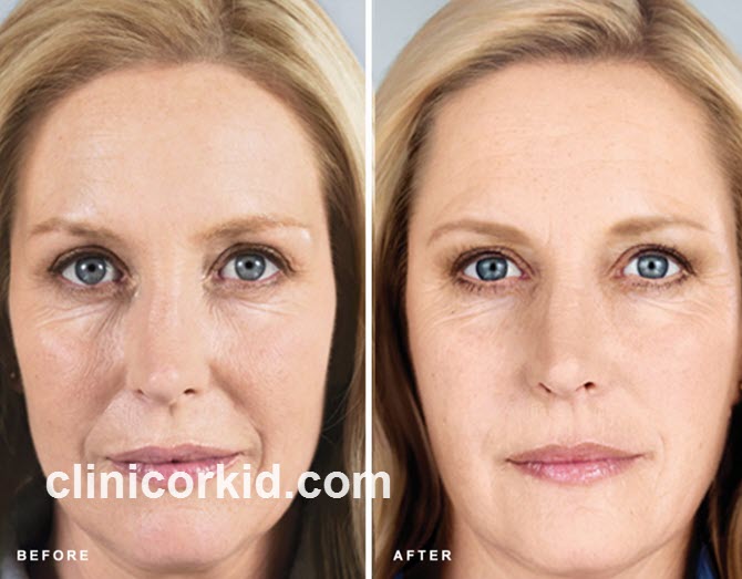 مراقبت های بعد از تزریق ژل خط لبخند | کلینیک ارکید