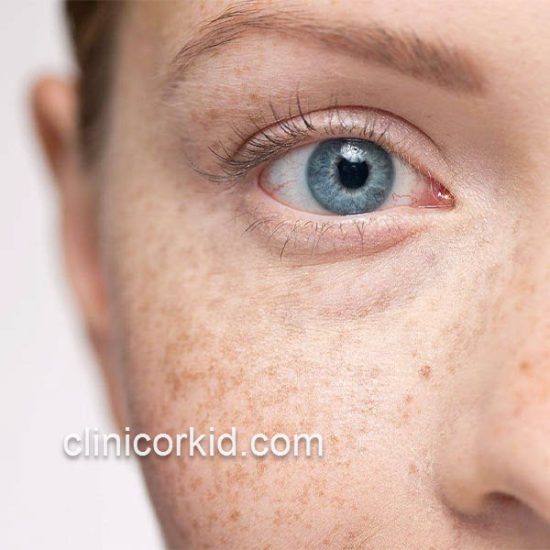 لیزر لکه های قهوه ای پوست در غرب تهران | کلینیک ارکید