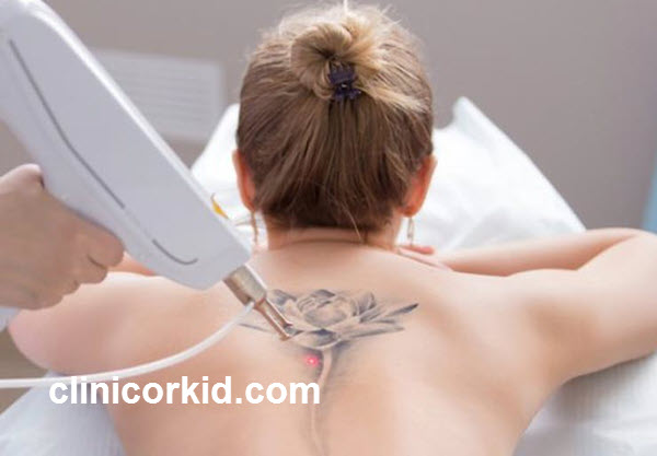 بهترین دستگاه لیزر برای پاک کردن تتو قدیمی | کلینیک ارکید