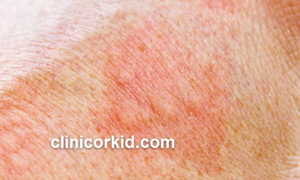 علل سوختگی ناشی از لیزر موهای زائد | کلینیک ارکید