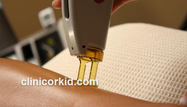 داروهای ممنوعه در طول دوره لیزر | کلینیک ارکید