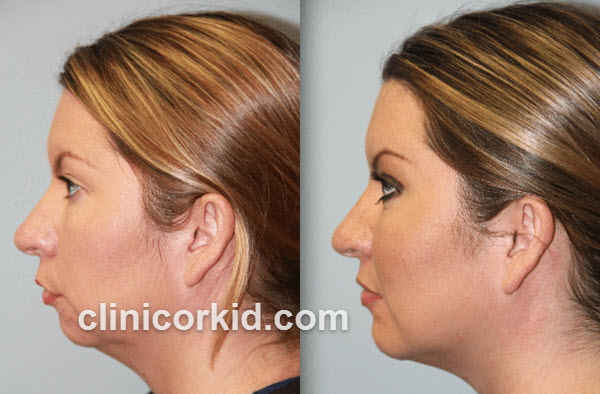 تاثیر تزریق ژل به چانه در زیبایی صورت | کلینیک ارکید