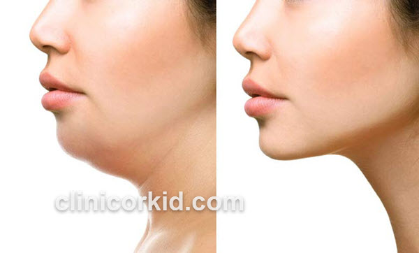 بررسی کاربرد های تزریق ژل | کلینیک ارکید