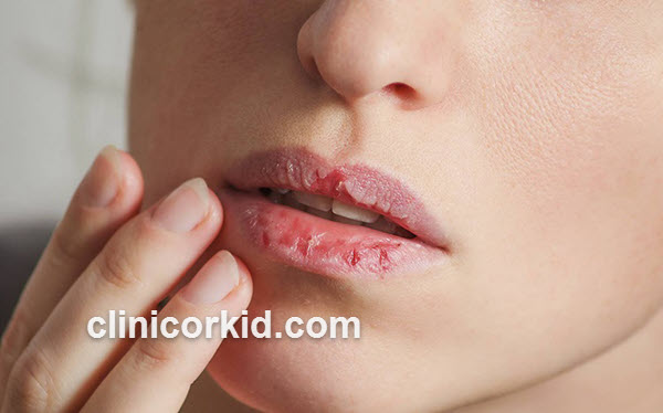 چه مدت بعد از مصرف راکوتان می توان لیزر کرد؟ | کلینیک ارکید