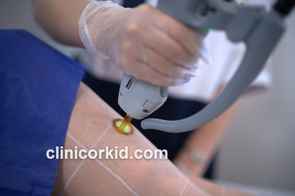 چه مدت بعد از مصرف راکوتان می توان لیزر کرد؟ | کلینیک ارکید