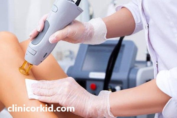 لیزر با دستگاه الکساندرایت کندلا 2023 | کلینیک ارکید