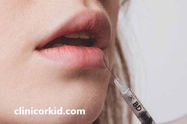 بررسی نکات مهم قبل از تزریق فیلر لب | کلینیک ارکید
