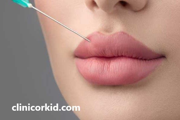 مراقبت های بعد از فیلر لب | کلینیک ارکید