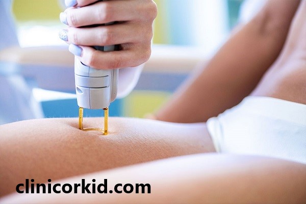لیزر بیکینی با بهترین دستگاه | کلینیک ارکید