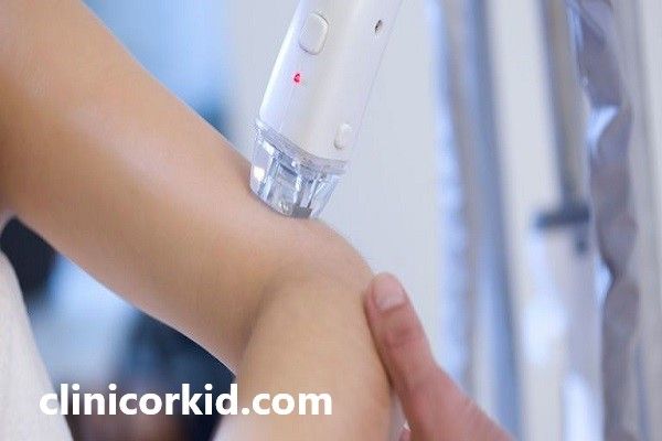 لیزر موهای نازک با قیمت مناسب | کلینیک ارکید