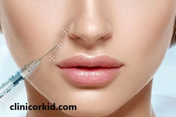 تزریق چربی برای رفع خط خنده اطراف دهان | کلینیک ارکید
