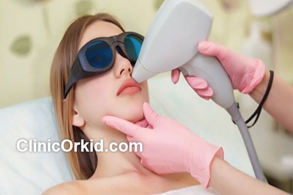 چرا لیزر، موهای نازک را ضخیم میکند؟ | کلینک ارکید