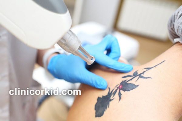 چند جلسه برای پاک کردن تاتو نیاز است؟ | کلینیک ارکید