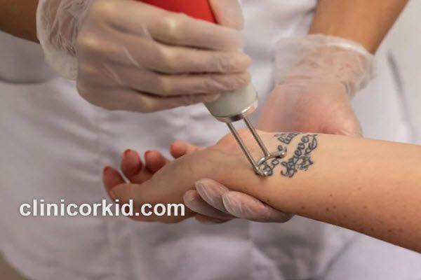 هزينه پاک كردن تاتو با ليزر در سال 1403 چقدر است؟ | کلینیک ارکید