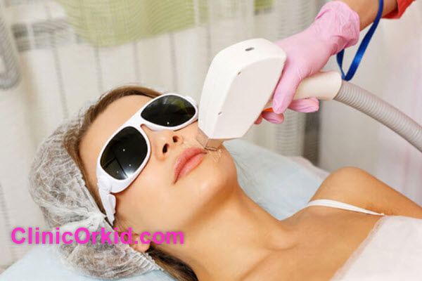 آیا موهای زائد به طور دائمی با لیزر از بین میرود؟ | کلینیک ارکید