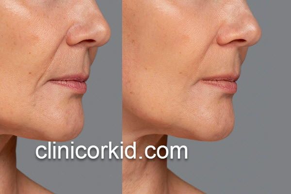 درمان منافذ باز صورت با مزوتراپی در کلینیک تخصصی | کلینیک ارکید