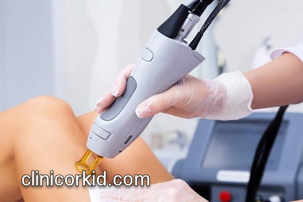 حذف موهای زائد با دستگاه پیشرفته | کلینیک ارکید