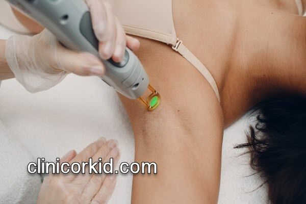 رفع موهای زائد با دستگاه پیشرفته | کلینیک ارکید