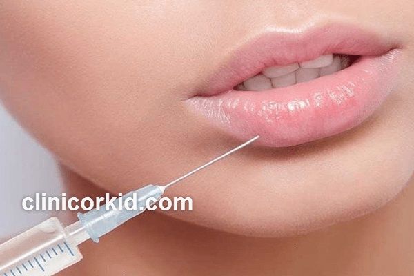 فیلر لب چیست؟ | کلینیک ارکید